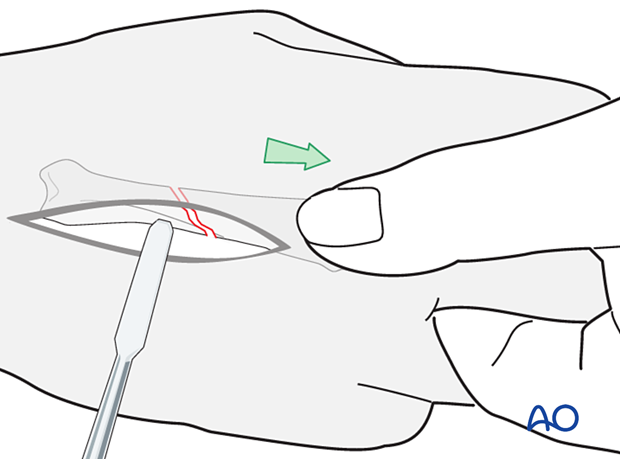 Reduction of an oblique metacarpal fracture