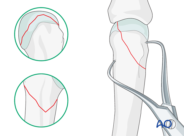 Reduction of an oblique metacarpal fracture with reduction 