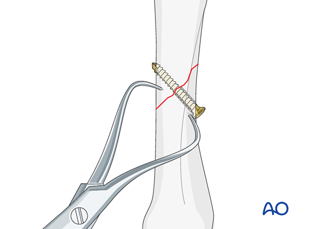 Lag screw fixation with neutralization plate of an oblique metacarpal fracture – lag screw insertion