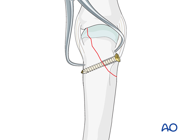 Lag screw fixation with neutralization plate of an oblique metacarpal fracture – lag screw insertion