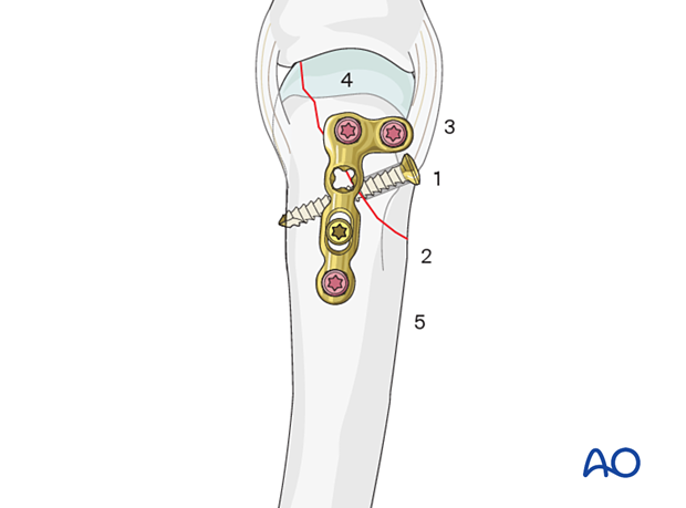 Lag screw fixation with neutralization plate of an oblique metacarpal fracture – order of screw insertion