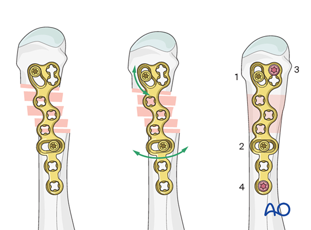 Bridge plating of a multifragmentary fracture of a metacarpal shaft with a plate comprising oblong holes