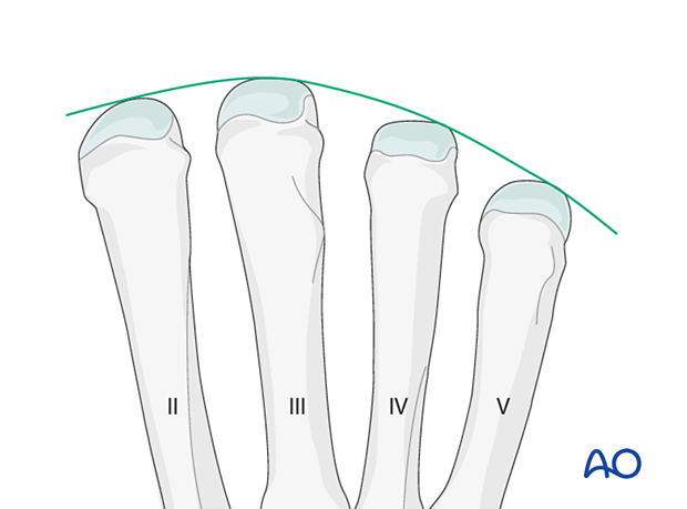 Arch of the metacarpal heads II–V