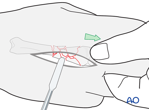 Reduction of a multifragmentary extraarticular fracture of the distal metacarpal