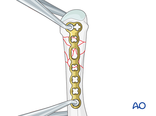 Bridge plating of a multifragmentary extraarticular fracture of the distal metacarpal – plate application