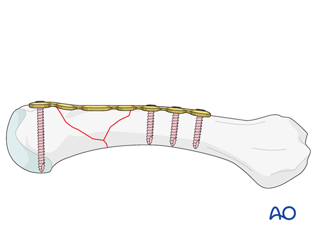 Bridge plating of a wedge extraarticular fracture of the distal metacarpal