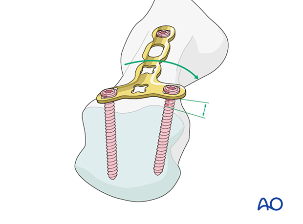 Bridge plating of a multifragmentary extraarticular fracture of the distal metacarpal – contouring around the articular block