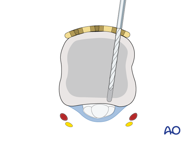 Compression with a T-plate of a transverse extraarticular fracture of the metacarpal head – distal screw insertion