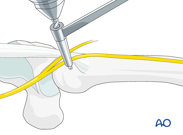 Intramedullary K-wire fixation of extraarticular metacarpal head fractures – Opening the cortex