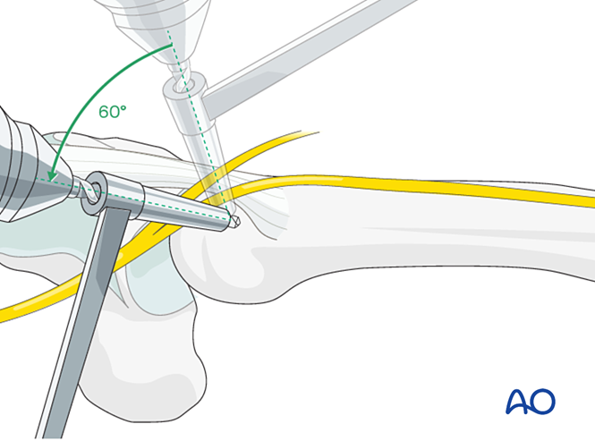 Intramedullary K Wire Fixation For Extraarticular Fracture Of The