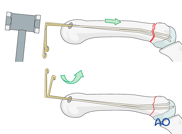 Intramedullary K-wire fixation of extraarticular metacarpal head fractures – Reduction with K-wires