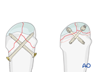 Screw fixation with cortical screws or headless screws of a complete articular fracture of a metacarpal head