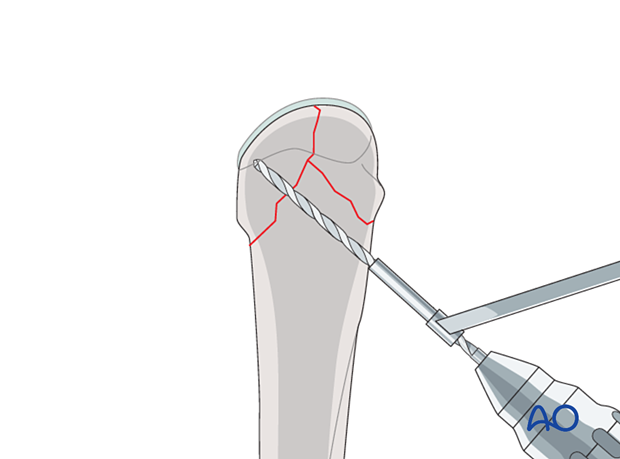 Screw fixation of a complete articular fracture of the metacarpal head – drilling