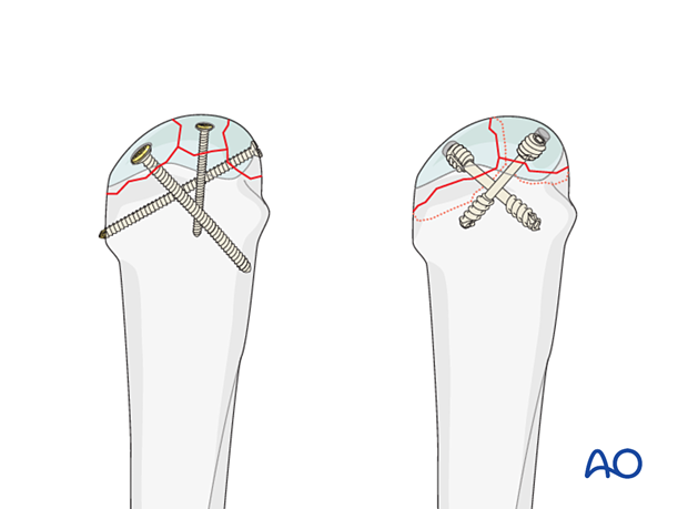 Screw fixation of a complete articular fracture of the metacarpal head – retrograde screw fixation of small fragments