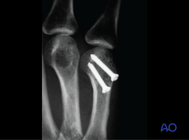 Oblique x-ray showing a case of an oblique partial articular fracture of the 5th metacarpal head stabilized with screws