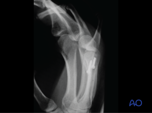 Transverse x-ray showing a case of an oblique partial articular fracture of the 5th metacarpal head stabilized with screws