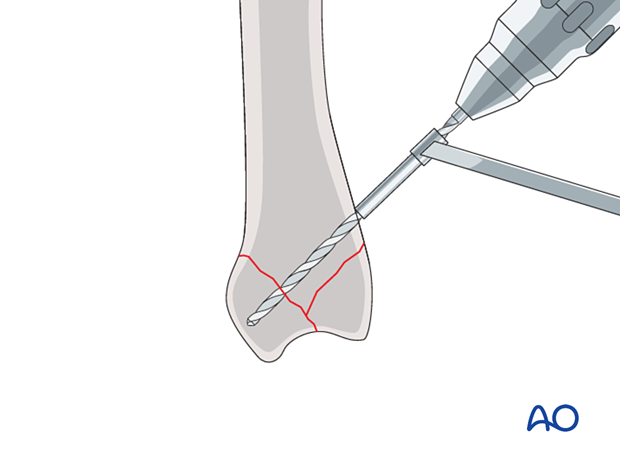 Screw fixation of a complete articular fracture of a metacarpal base - Drilling