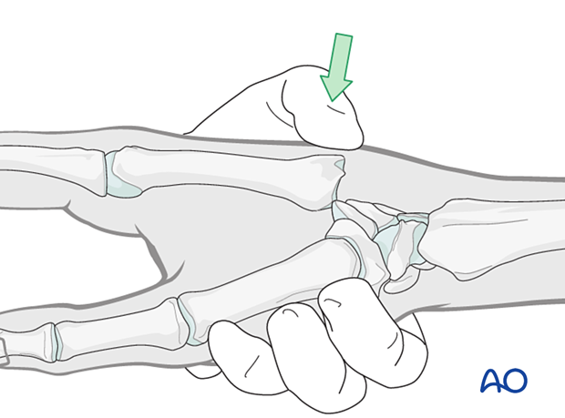 Reduction of a dislocated CMC joint