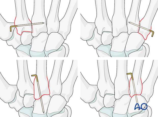 K-wire stabilization of carpometacarpal joints