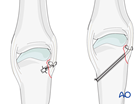 Collateral-ligament reattachment with suture anchor and bone tunnel at a metacarpal head