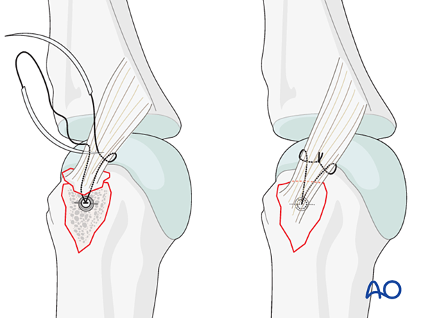 Anchor inserted in anchor hole – collateral ligament reattachment of an avulsion fracture of the metacarpal head