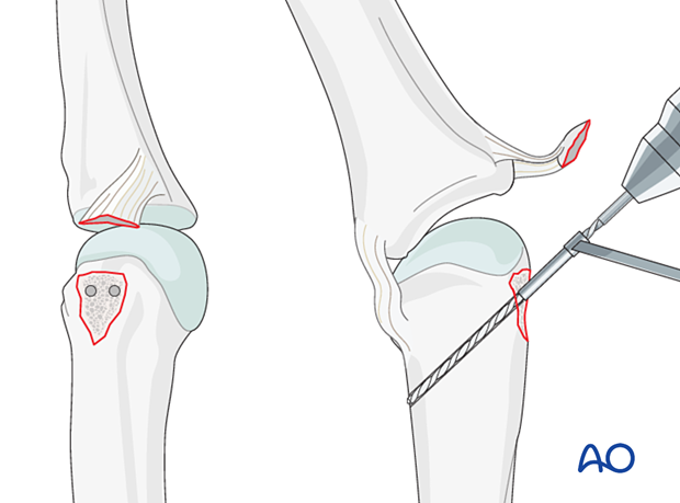 Drilling of parallel perforation holes – collateral ligament reattachment of an avulsion fracture of the metacarpal head