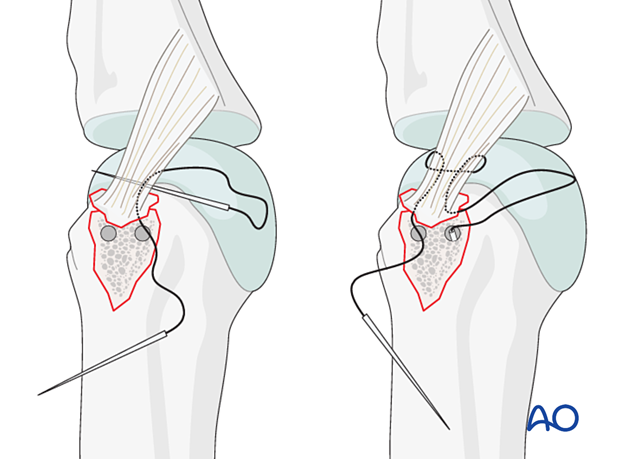 Suture insertion in perforation holes – collateral ligament reattachment of an avulsion fracture of the metacarpal head