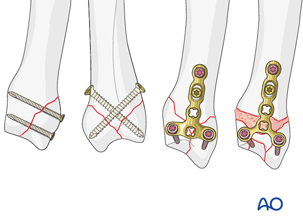 Open reduction and fixation for the management of articular metacarpal base fractures