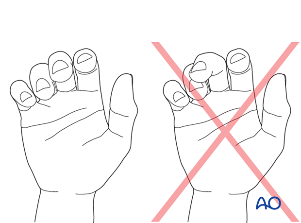 Normal rotational alignment of the fingers and rotational malalignment of the middle finger