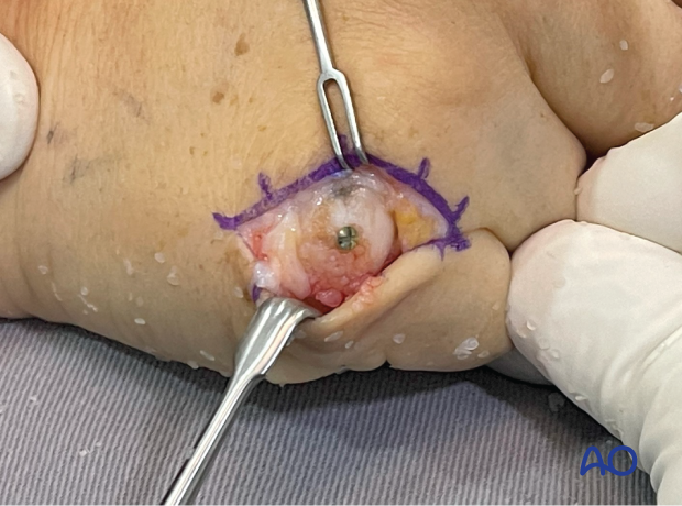 severe inflammatory reaction and cartilage compromise in a 5th metacarpal head fracture with screw fixation