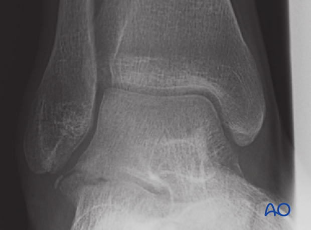 direct lateral approach to the talus