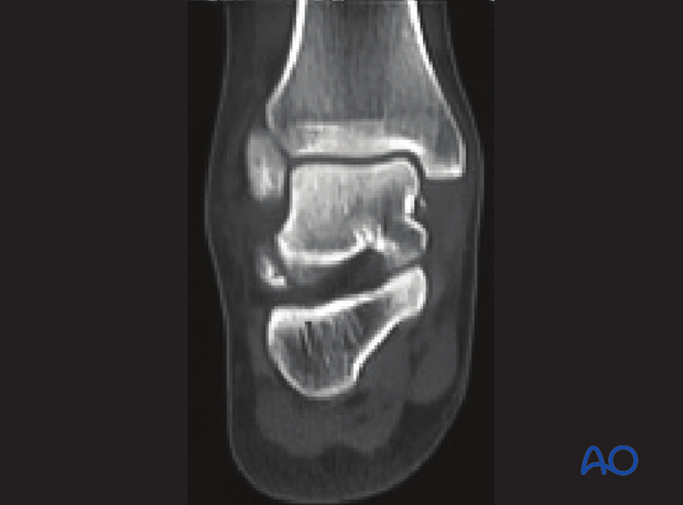 orif screw fixation