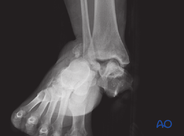 medial malleolar osteotomy