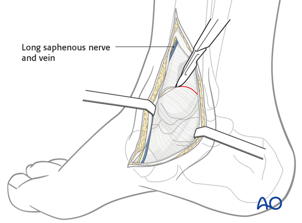 medial malleolar osteotomy