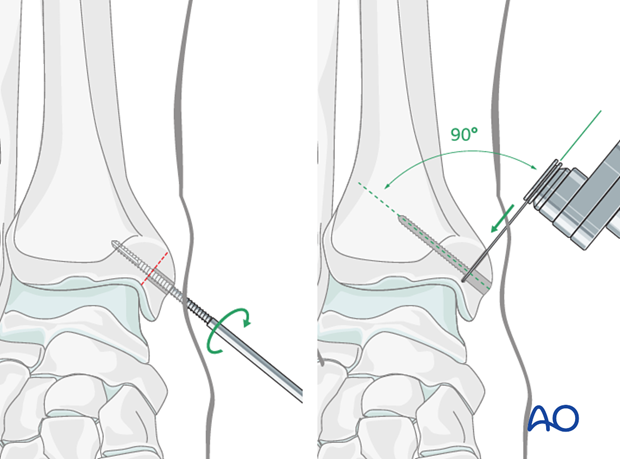 medial malleolar osteotomy