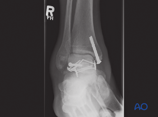 medial malleolar osteotomy