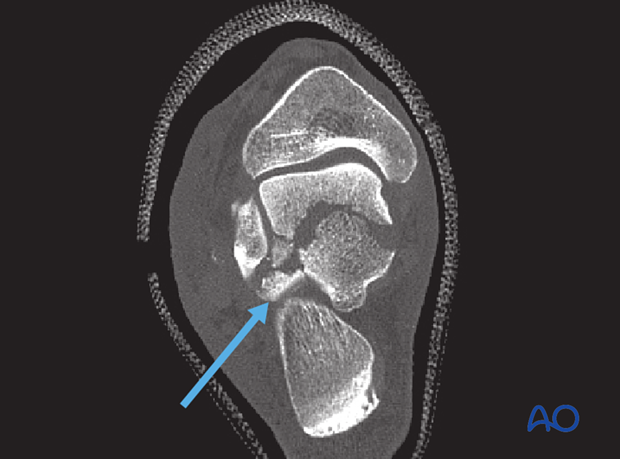 anterolateral approach to the talus