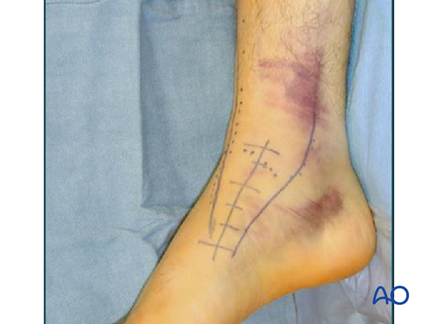 anteromedial approach to the talus