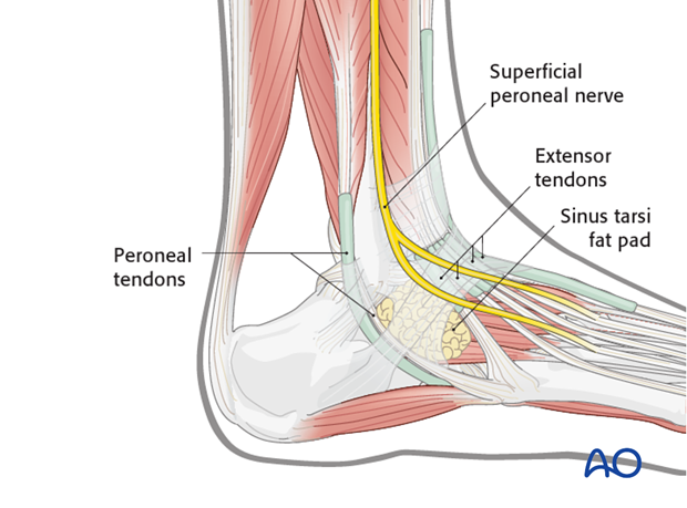 direct lateral approach to the talus