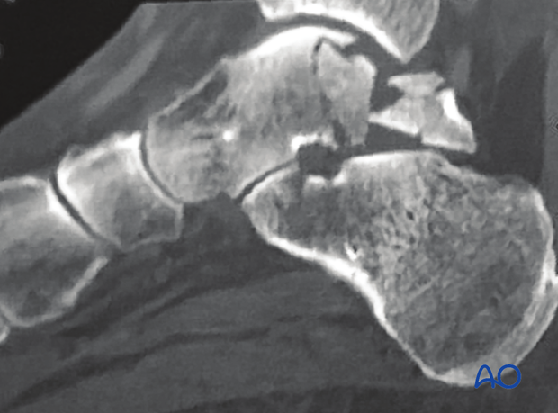 posteromedial approach to the talus