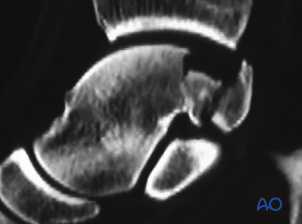 posteromedial approach to the talus