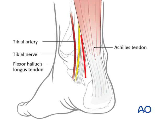 posteromedial approach to the talus