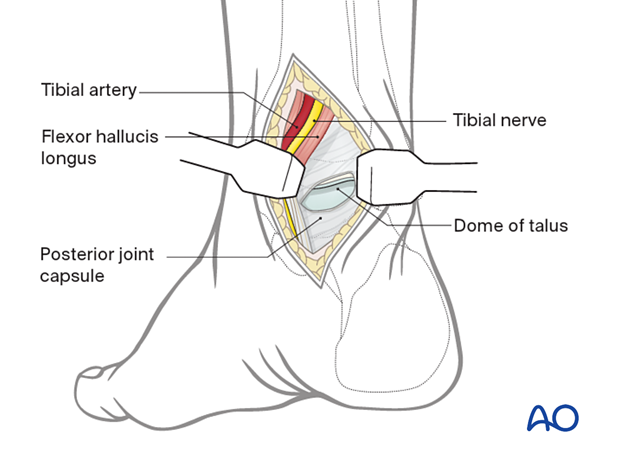 posteromedial approach to the talus