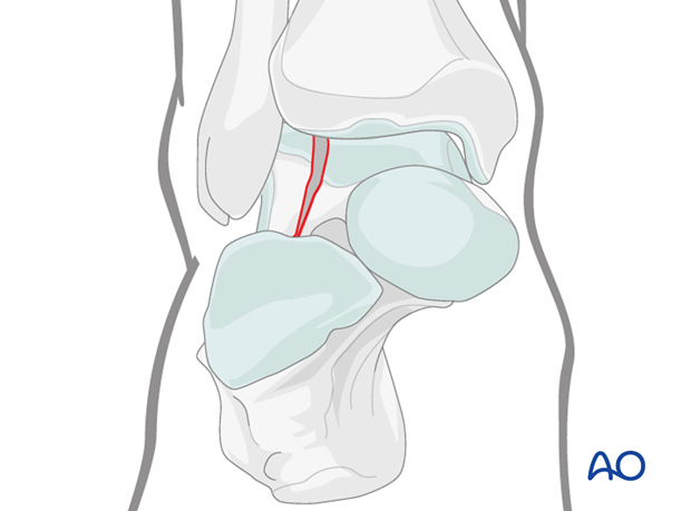 lateral malleolar osteotomy