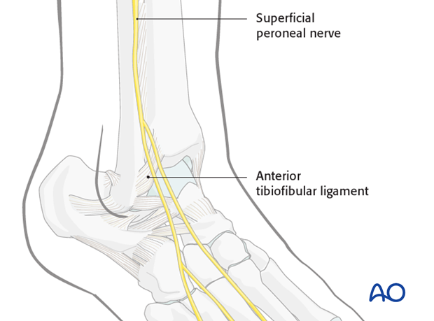 lateral malleolar osteotomy