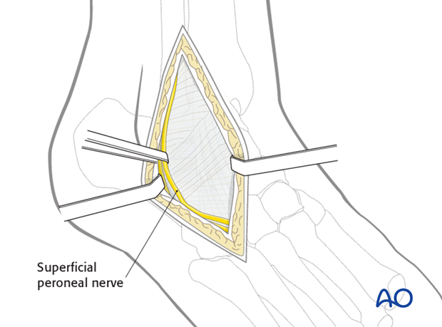 lateral malleolar osteotomy