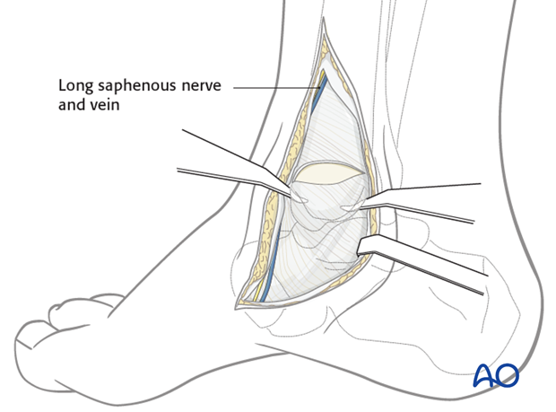 medial malleolar osteotomy