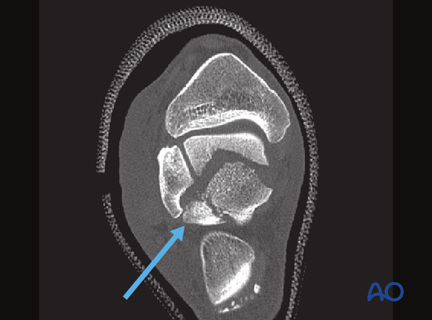 posterolateral approach to the hindfoot