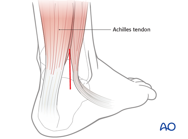 Posterolateral approach to the hindfoot