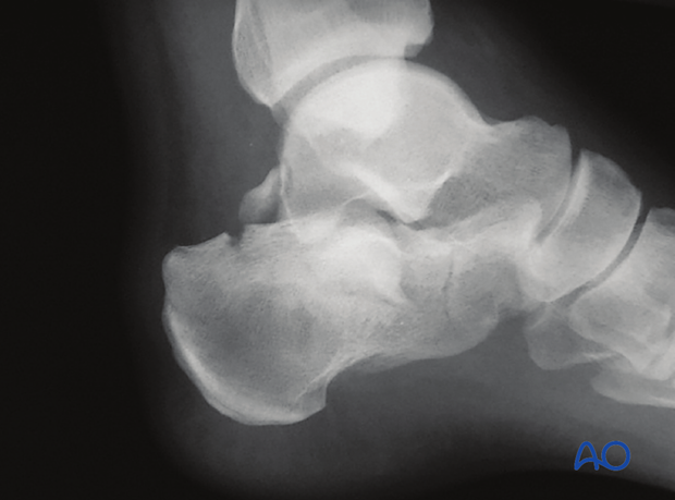 extended lateral approach to the calcaneus